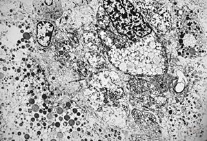 M,58y. | retroperitoneal liposarcoma M,58y. | retroperitoneal liposarcoma